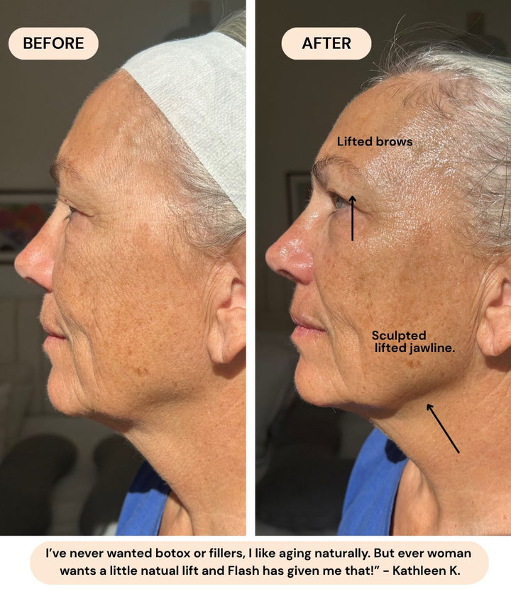 Before and after: Kathleen K. with lifted brows and a more sculpted jawline. She says Flash gave her a natural lift without botox or fillers.
