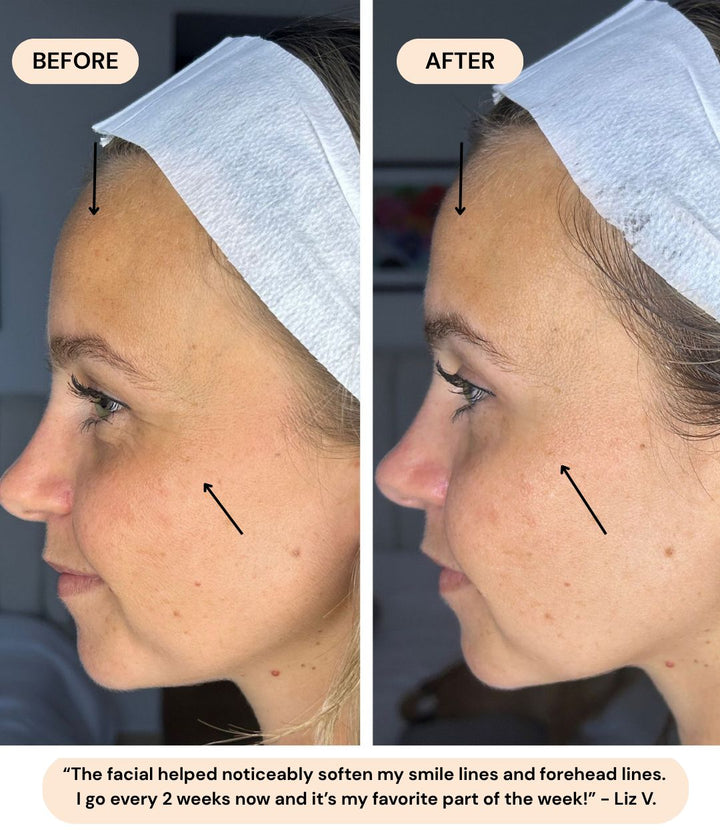 Before and after: Liz V. with softer smile lines and forehead lines. She now comes every 2 weeks.